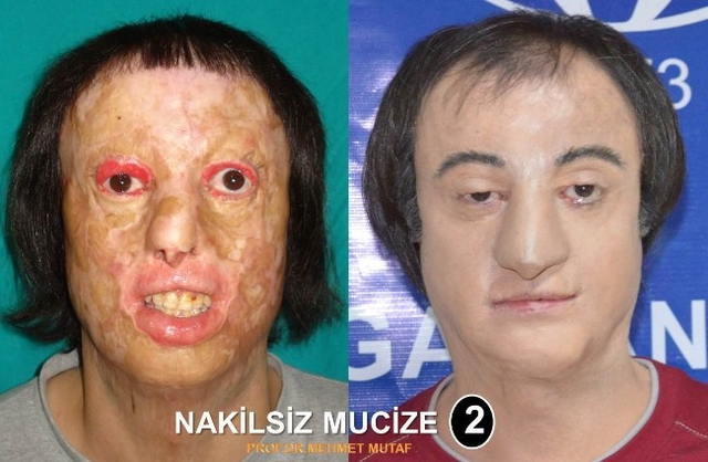 Gaziantep'te 2. Kez Nakilsiz Yüz Yapıldı