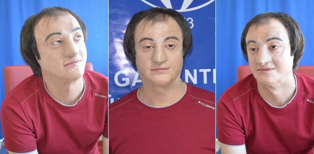 Gaziantep'te 2. Kez Nakilsiz Yüz Yapıldı