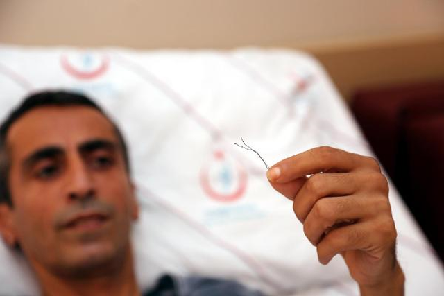Bağırsağından 10 Santimlik Tel Çıktı