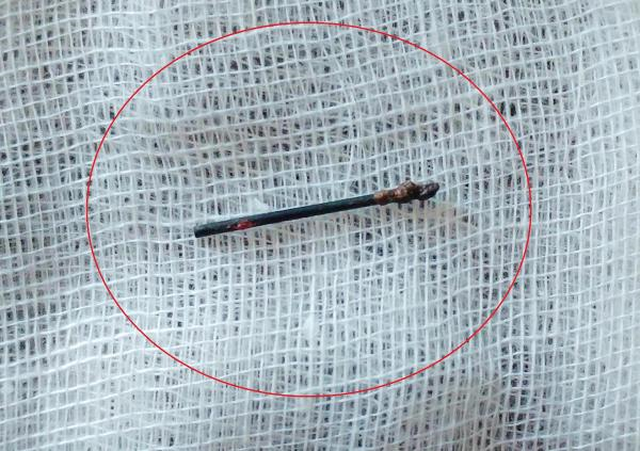 Yıllardır Göğüs Kafesinde İğne İle Yaşayan Genç Doktorları Bile Şaşırttı