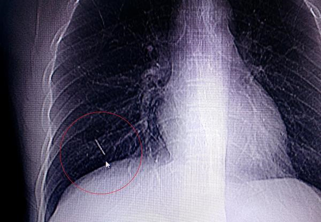 Yıllardır Göğüs Kafesinde İğne İle Yaşayan Genç Doktorları Bile Şaşırttı