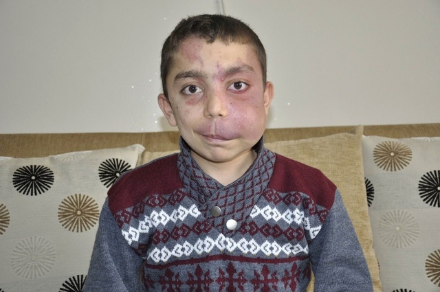 Ölümcül Hastalıklı Çocuk, Tedavi Masraflarının Karşılanmasını İstiyor