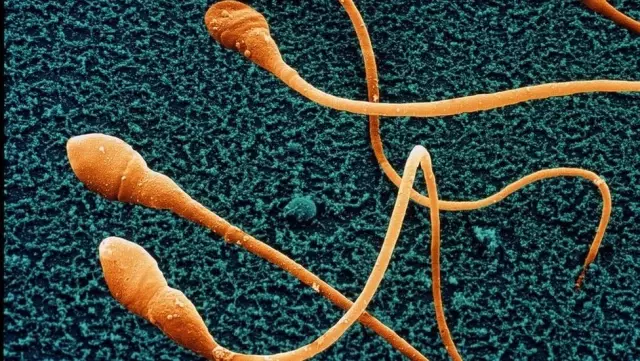 Sperm Sayısı 50 Yılda Yüzde 50 Azaldı! İnsanlığın Sonu Gelebilir