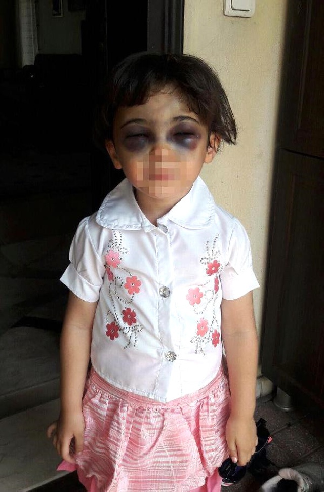 Üvey Anne Şiddetine Maruz Kalan Kız Çocuğunun Öz Annesi Şikayetçi Oldu
