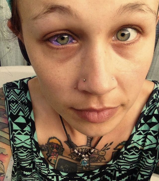 Gözünün Akına Dövme Yaptırmaya Gitti, Kısmen Kör Olarak Çıktı