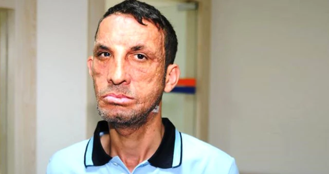 Türkiye'nin İlk Yüz Nakli Olan İsmi Uğur Acar Cinayet Davasından Beraat Etti