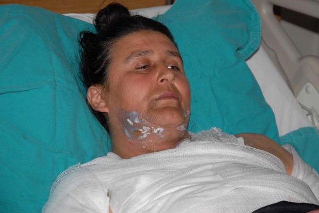 Kocasının Sevgilisi Tarafından Üzerine Kaynar Su Döküldü!