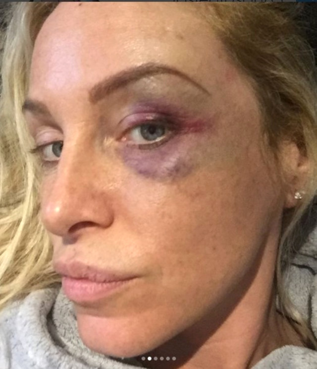 Ünlü Televizyon Yıldızı Josie Gibson, Bindiği Takside Saldırıya Uğradı