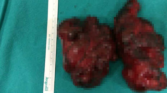 Boğazından 650 Gram Kitle Çıkarıldı