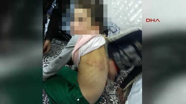Babasından İşkence Gören Suriyeli Kız, Devlet Korumasına Alındı