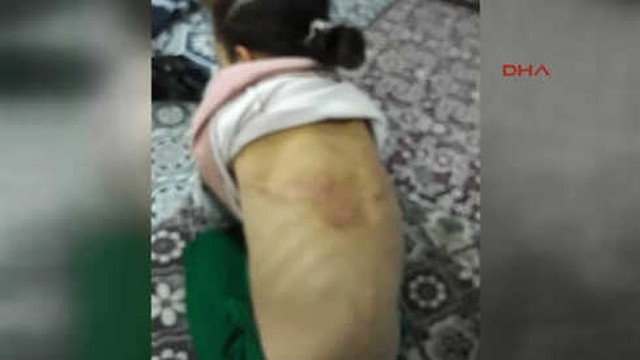 Babasından İşkence Gören Suriyeli Kız, Devlet Korumasına Alındı