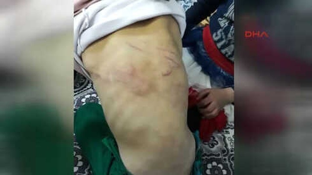 Babasından İşkence Gören Suriyeli Kız, Devlet Korumasına Alındı
