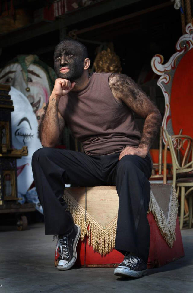 Suratının Yüzde 98'i Kıllarla Kaplı! Dünyanın En Kıllı İnsanı Artık Çok Mutlu