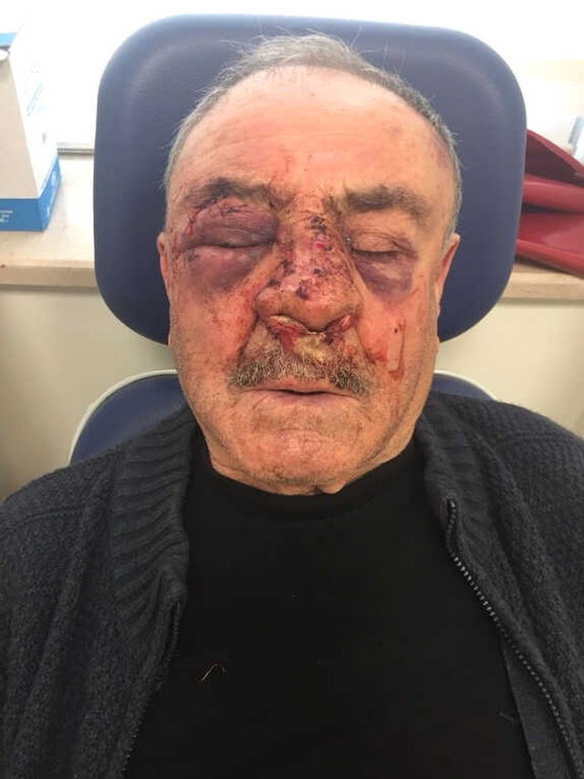 İzmir'de Komşusundan 1,5 Yıllık Aidatı İsteyen Yaşlı Adam, Hastanelik Oldu