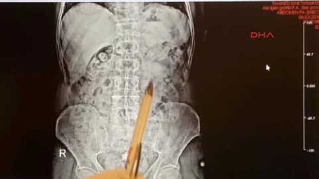 İzmir'de Yabancı Uyruklu 2 Kişinin Midesinden 810 Gram Uyuşturucu Çıktı