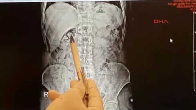 İzmir'de Yabancı Uyruklu 2 Kişinin Midesinden 810 Gram Uyuşturucu Çıktı