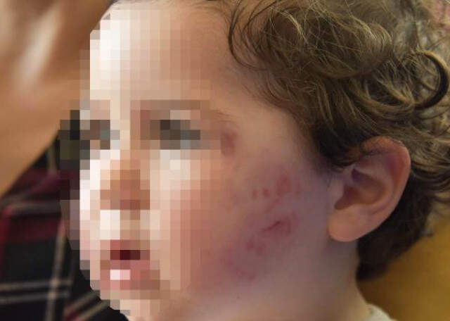 Kreşte 1,5 Yaşındaki Bebeğe Dayak! Yüzü Mosmor ve Isırıklarla Dolu