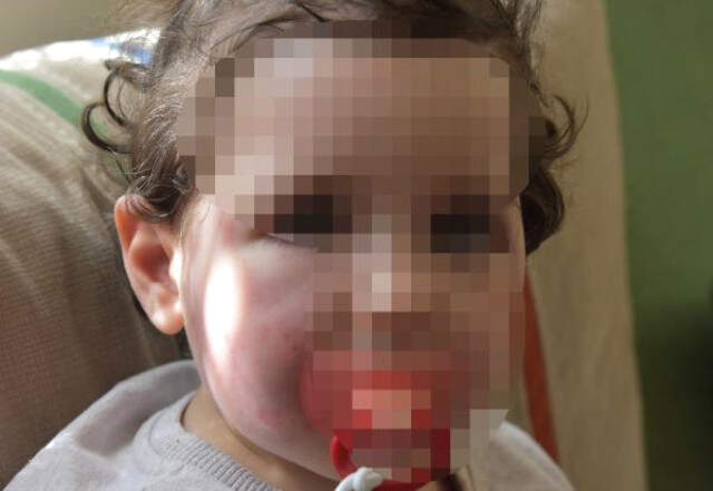 Kreşte 1,5 Yaşındaki Bebeğe Dayak! Yüzü Mosmor ve Isırıklarla Dolu