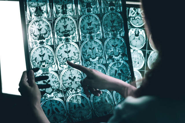 Alzheimer Belirtisine İşaret Eden 10 Önemli Soru