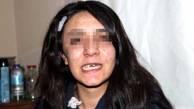 Erkek Arkadaşı Tarafından Dişi Kırılan Genç Kızın İsyanı: Korunmaya İhtiyacımız Var