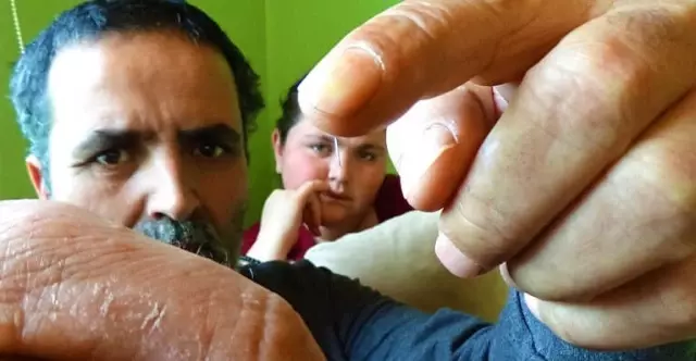 8 Yıl Önce Vücudundan 35 İğne Çıkarılan Genç Kızın Vücudu Yine İğne Üretmeye Başladı