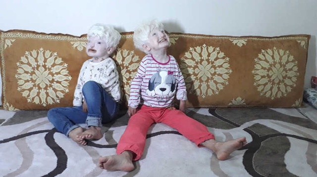 Doğuştan Albino ve İşitme Engelli Kardeşler Yardım Bekliyor