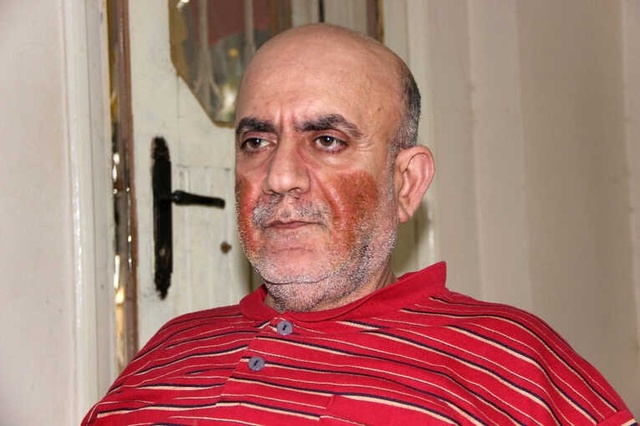 Yüzünde Çıkan Yaralar Nedeniyle Günden Güne Eriyor