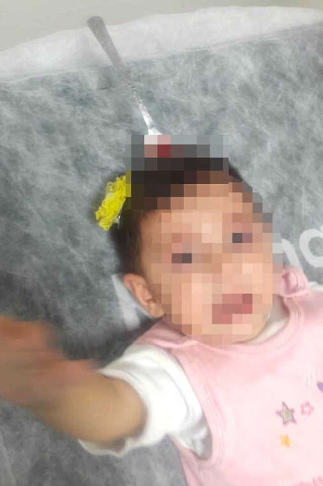 İzmir'de Akılalmaz Olay! Bebeğin Kafasına Çatal Saplandı