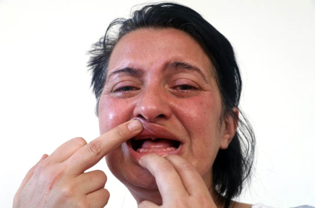 Dişlerini Beyazlatmak İsteyen Talihsiz Kadın, 32 Dişini Birden Kaybetti