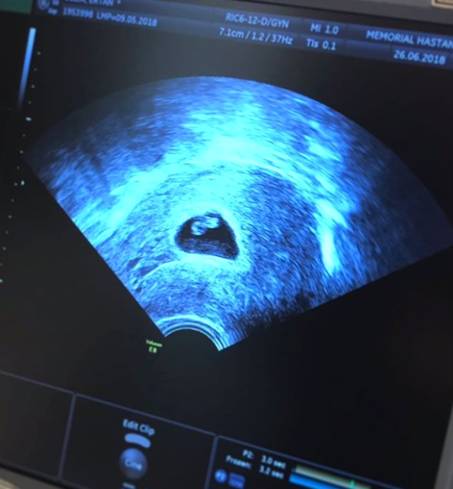 6 Haftalık Hamile Olan Siren Ertan, Bebeğinin Kalbinin Yavaş Attığını Öğrendi