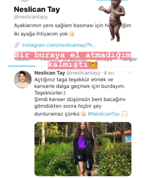 Kanserden Bacağını Kaybeden Genç Kız 3. kez Kansere Yakalandı