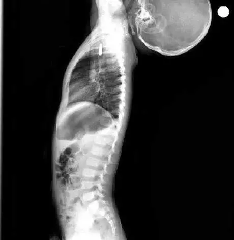 Batman'da 1,5 Yaşındaki Berfin'in Yuttuğu Pil Operasyonla Alındı