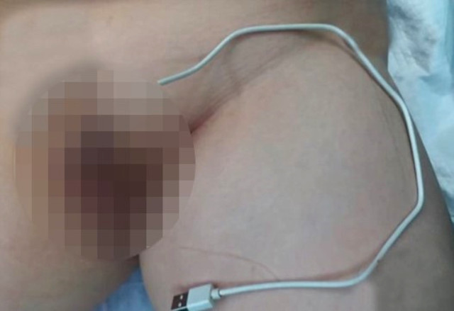 Cinsel Organına USB Kablosu Sıkışan Meraklı Erkek Çocuğu Hastanelik Oldu