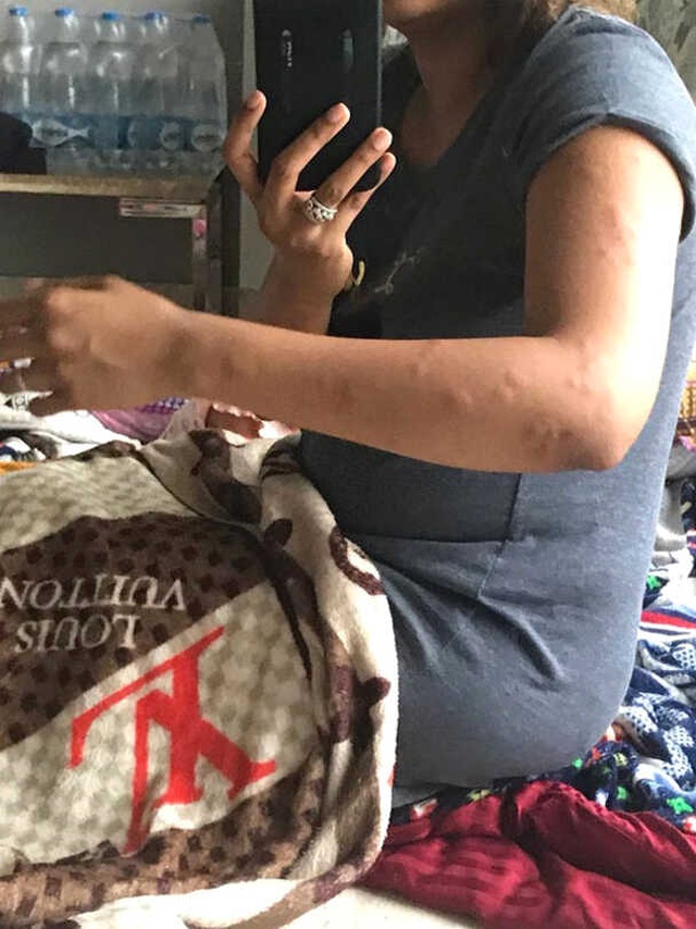 Hindistan Hava Yolları, Business Sınıfında Tahtakurularının Isırdığı Yolcularından Özür Diledi