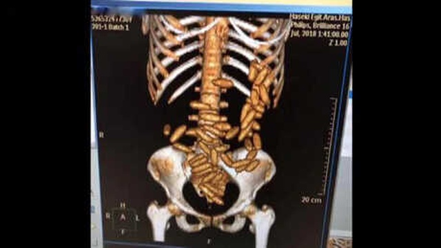 Havalimanında Operasyon! Brezilya'dan Gelen Kadının Midesinden 51 Kapsül Kokain Çıktı