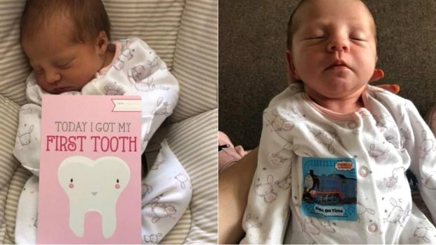Ağzında Dişle Doğan 12 Günlük Bebeğin Dişini Çektiler