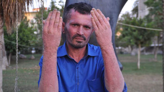 Sedef Hastası Vatandaşın Tedavi Olduktan Sonra Hayatını Değişti Sedef Hastası Vatandaşın Tedavi Olduktan Sonra Hayatını Değişti