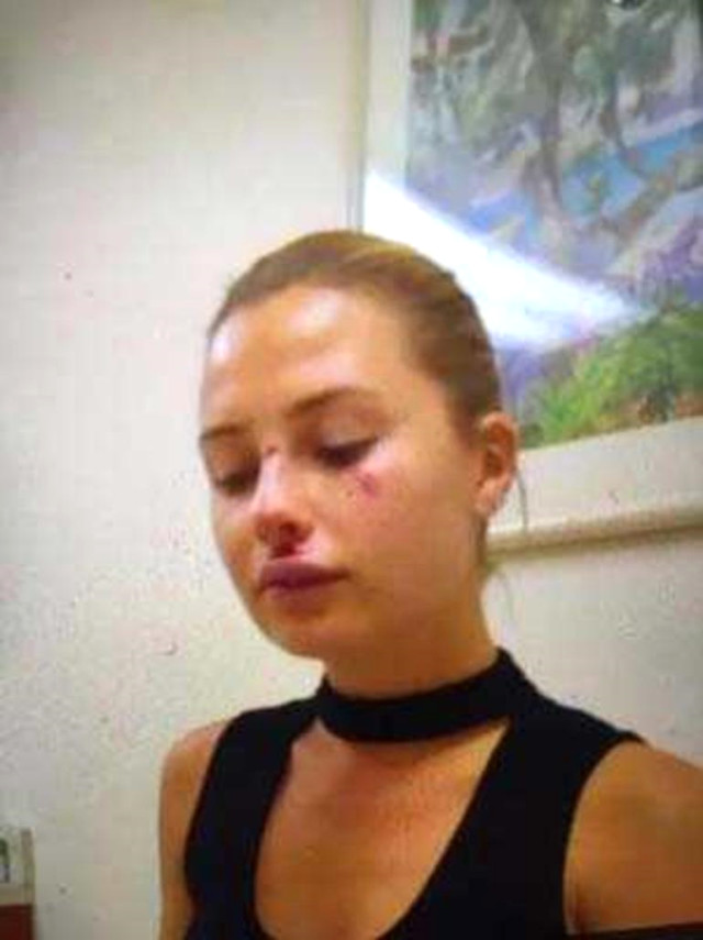 Serdar Ortaç'ın Eşi Chloe Loughnan Trafik Kazası Geçirdi