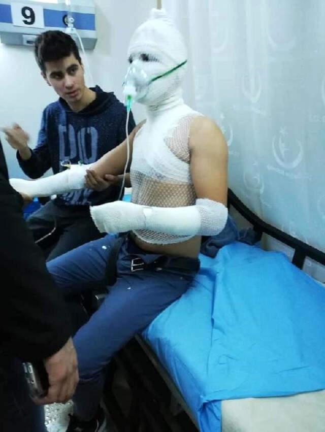 Lise Öğrencisi, Mutfakta Deney Yaparken Oluşan Patlamada Yandı