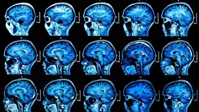 Uçuk Virüsü Alzheimer'a mı Yol Açıyor?