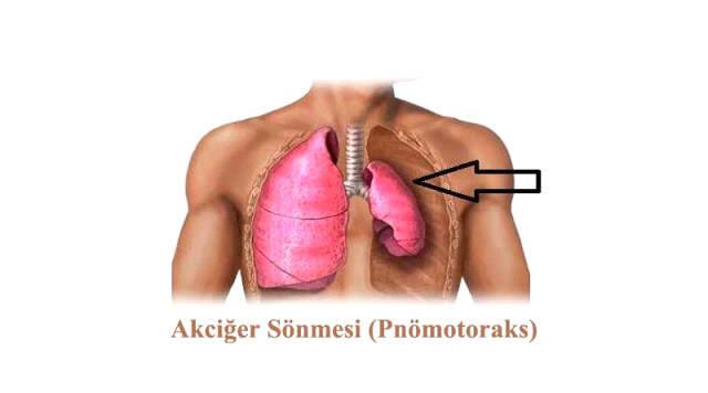 Galatasaray'da oynayan Nagamoto'nun Yaşadığı Akciğer Sönmesi Nedir? Belirtileri Nelerdir?