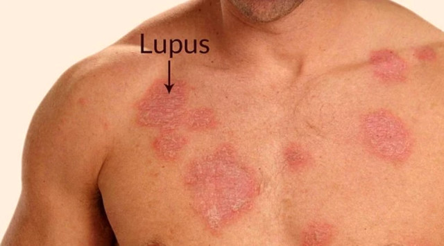 Lupus Hastalığı Nedir? Lupus Hastalığının Belirtileri Nelerdir?