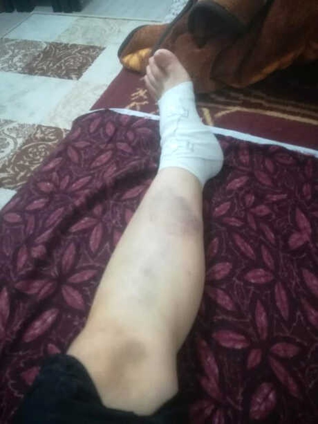Eski Kız Arkadaşının Boynunu Kırıp Dişlerini Döken Cani Sevgili, Çıplak Fotoğraflarıyla Şantaj Yaptı