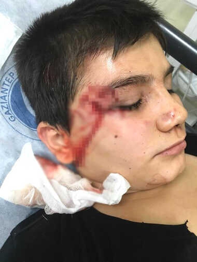 Pitbull'un Saldırdığı Çocuğu, Vatandaşlar Zor Kurtardı
