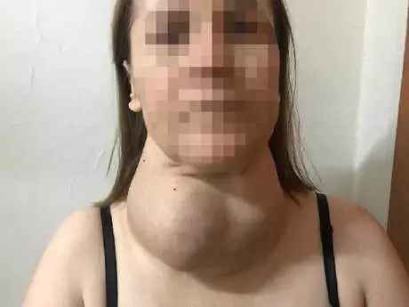 Ameliyattan Korkan Kadının Boynundan 1 Kilo 100 Gram Ağırlığında Guatr Çıkarıldı