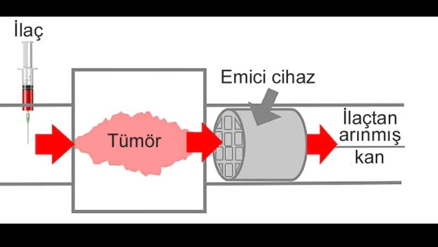 Kemoterapinin Yan Etkileri Süngerimsi Cihazla Azaltılabilir