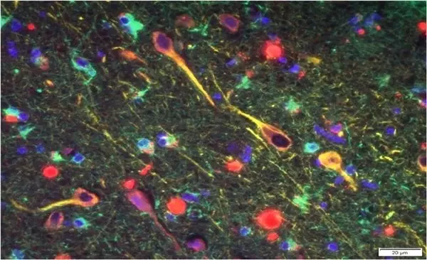 Araştırmalara Göre Alzheimer Hastalığının Yayılmasında Bir Numaralı Şüpheli: Ağzımız