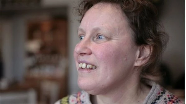 Yüz Körlüğü Hastalığı Nedeniyle Kendi Yüzünü Bile Tanıyamayan Kadın