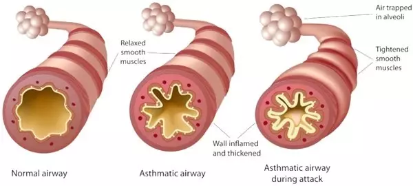 <a class='keyword-sd' href='/omega/' title='Omega'>Omega</a> 3 Astım Şiddetini Azaltırken Omega 6'nın Artırdığı Ortaya Çıktı