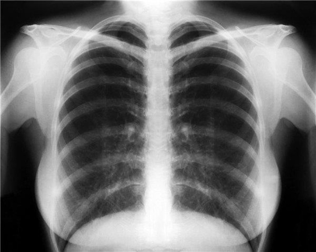 Bu Ücretsiz Yapay Zeka, Röntgen Filmlerini Doktorlar Kadar İyi Okuyabiliyor